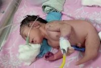 ویدئو/ فیلم تولد عجیب خلقه ترین نوزاد جهان! / نه پری دریایی نه انسان