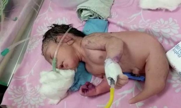 ویدئو/ فیلم تولد عجیب خلقه ترین نوزاد جهان! / نه پری دریایی نه انسان