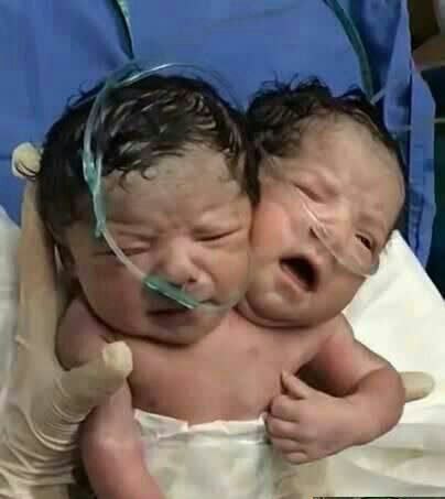 تصویری از یک نوزاد دو سر که پربازدید شد